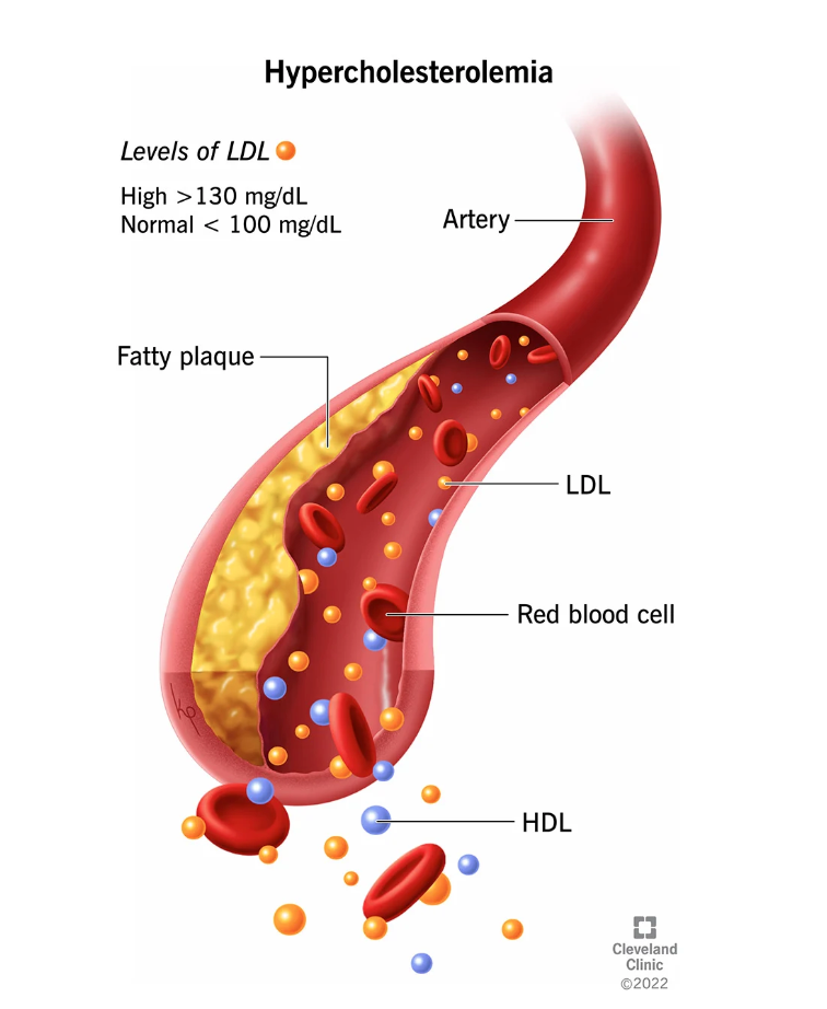 플라크가 쌓여 동맥벽에 달라붙는 현상, Cleveland Clinic.